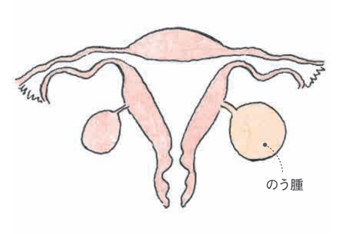 卵巣のう腫